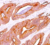 Pan Cytokeratin Antibody colon carcinoma IHC. Immunohistochemistry analysis of cytokeratin expression in FFPE human colon carcinoma using Pan Cytokeratin antibody clone AE1/AE3. Strong cytoplasmic HRP-DAB brown staining highlights malignant epithelial cells forming glandular tumor structures, with clear delineation of carcinoma architecture against surrounding stromal tissue. The staining pattern supports epithelial lineage identification and is consistent with broad cytokeratin expression in carcinoma cells.