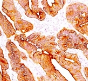 IHC testing of FFPE human colon carcinoma and Multi Cytokeratin antibody (clone C11).