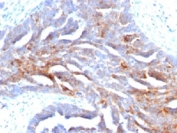 TAG-72 Antibody Ovarian Carcinoma IHC. Immunohistochemistry analysis of human ovarian carcinoma tissue stained with TAG-72 antibody recognizing tumor associated glycoprotein 72 (CA72-4), clone B72.3. Tumor epithelial cells show strong membranous and cytoplasmic staining, consistent with expression of mucin-associated glycoproteins carrying TAG-72 epitopes. The staining pattern highlights carcinoma cell populations with characteristic altered glycosylation, while surrounding stromal elements show minimal signal. Hematoxylin counterstain highlights nuclei in blue.