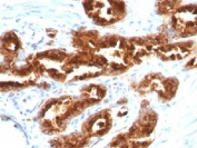 TAG-72 Antibody Prostate Carcinoma IHC. Immunohistochemistry analysis of FFPE human prostate carcinoma tissue stained with TAG-72 antibody recognizing tumor associated glycoprotein 72 (CA72-4), clone B72.3. Tumor epithelial cells demonstrate strong membranous and cytoplasmic staining, consistent with expression of mucin-associated glycoproteins bearing TAG-72 carbohydrate epitopes and characteristic of carcinoma-associated glycosylation. Surrounding stromal regions show minimal staining, supporting selective detection of malignant epithelial cell populations. Hematoxylin counterstain highlights nuclei in blue.