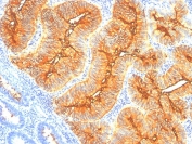 TAG-72 Antibody Colon Carcinoma IHC. Immunohistochemistry analysis of FFPE human colon carcinoma tissue stained with TAG-72 antibody recognizing tumor associated glycoprotein 72 (CA72-4), clone B72.3. Tumor epithelial cells display strong membranous and cytoplasmic staining, highlighting mucin-associated glycoproteins with characteristic TAG-72 carbohydrate epitopes. The staining pattern emphasizes carcinoma glandular structures with luminal and apical enrichment, consistent with altered glycosylation in malignant epithelial cells, while surrounding stromal tissue shows minimal signal. Hematoxylin counterstain highlights nuclei in blue.