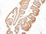 Immunohistochemistry of PSA / Prostate Specific Antigen in human prostate carcinoma. Formalin-fixed, paraffin-embedded human prostate carcinoma tissue stained with PSA/Prostate Specific Antigen antibody (clone KLK3/801) shows strong cytoplasmic and luminal staining in malignant prostate epithelial cells forming glandular structures, with minimal staining in surrounding stromal cells. Antigen retrieval was performed by boiling tissue sections in 10 mM citrate buffer, pH 6.0, for 10-20 minutes, followed by cooling at room temperature for 20 minutes.