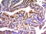 p21 Antibody Colon Carcinoma Tissue IHC. Immunohistochemistry analysis of formalin-fixed, paraffin-embedded human colon carcinoma stained with p21 antibody (clone DCS-60.2).