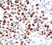 p21 / p21WAF1 Antibody Lung Squamous Cell Carcinoma IHC. Immunohistochemistry: Formalin-fixed, paraffin-embedded human lung squamous cell carcinoma (SCC) stained with p21 antibody (clone CIP1/823).