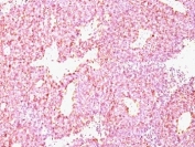 Chromogranin A Antibody SC Lung Carcinoma IHC. Immunohistochemistry staining of formalin-paraffin human SC lung carcinoma with Chromogranin A antibody (clone CHGA/798).