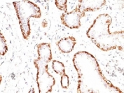 Calponin 1 Antibody Breast Carcinoma IHC. Immunohistochemistry analysis of FFPE human breast carcinoma tissue using Calponin 1 antibody. The mouse monoclonal antibody clone CNN1/832 shows strong HRP-DAB brown cytoplasmic staining in myoepithelial cells surrounding malignant glandular structures, while tumor epithelial cells remain largely negative. This pattern highlights smooth muscle and myoepithelial lineage cells and supports the use of Calponin 1 / CNN1 as a contractile marker for identifying myoepithelial cell layers in breast tissue.