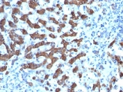 CPS1 Antibody Hepatocellular Carcinoma IHC: Immunohistochemistry testing of formalin-fixed, paraffin-embedded human hepatocellular carcinoma stained with CPS1 antibody (clone CPS1/1022).