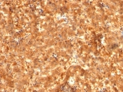 AFP Antibody HepG2 Cell IF. Immunofluorescence analysis of PFA-fixed human HepG2 cells using AFP Antibody (clones C2 + C3 + MBS-12, green) shows cytoplasmic and perinuclear staining consistent with Alpha fetoprotein localization within the secretory pathway of hepatocyte-derived cells. Redot nuclear counterstain (red) provides contrast to cell nuclei. The punctate cytoplasmic distribution supports detection of AFP as a secreted tumor marker protein in liver cancer cell models.