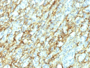 Fibronectin Antibody Renal Cell Carcinoma IHC. Immunohistochemistry analysis of FFPE human renal cell carcinoma tissue stained with Fibronectin Antibody clone 568. Strong extracellular and stromal HRP-DAB brown staining is observed throughout tumor-associated connective tissue regions, consistent with localization of Fibronectin 1 / FN1 within extracellular matrix remodeling and stromal organization pathways. Clone 568 recognizes the 8th Type III Repeat region of fibronectin, supporting detection of matrix-associated fibronectin deposited within the renal tumor microenvironment. HIER: boil tissue sections in 10 mM Tris with 1 mM EDTA, pH 9, for 10-20 min followed by cooling at RT for 20 min.