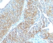 TRIM29 Antibody Mouse Monoclonal Esophageal Carcinoma Immunohistochemistry. IHC: Formalin-fixed, paraffin-embedded human esophageal carcinoma stained with mouse monoclonal TRIM29 antibody (clone TRIM29/1041).