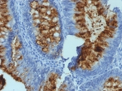 FUT3 Antibody Colon Carcinoma IHC. Immunohistochemistry analysis of FFPE human colon carcinoma tissue stained with FUT3 Antibody demonstrates strong membranous and granular apical HRP-DAB brown staining throughout gland-forming epithelial tumor cell populations, consistent with expression of Fucosyltransferase 3 / FUT3 within gastrointestinal-derived carcinoma tissue. This Lewis antigen biosynthesis antibody highlights epithelial glycosylation pathways and Lewis blood group-associated glycoconjugate organization involved in gastrointestinal epithelial differentiation and mucin-associated cellular signaling.