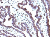 EMI1 Antibody Ovarian Carcinoma IHC. Immunohistochemistry analysis of formalin-fixed, paraffin-embedded human ovarian carcinoma tissue stained with EMI1 Antibody / Cell Cycle Checkpoint Regulator Antibody clone EMI1/1176 demonstrates prominent nuclear HRP-DAB brown staining throughout malignant epithelial cell populations, consistent with the role of Early mitotic inhibitor 1 / FBXO5 in proliferative signaling, APC/C-associated checkpoint regulation, and mitotic progression control. The predominantly nuclear staining pattern aligns with the function of EMI1 as a cell cycle regulatory protein involved in maintenance of orderly cell cycle progression and genomic stability.
