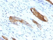 A Antigen Antibody Colon Carcinoma IHC. Immunohistochemistry staining of FFPE human colon carcinoma tissue using A Antigen Antibody demonstrates distinct membranous HRP-DAB brown staining in discrete epithelial tumor cell populations. The staining pattern is consistent with expression of Blood Group Antigen A / ABO Antigen A, a terminal carbohydrate epitope of the ABO blood group system expressed on cell surface glycoproteins and glycolipids. Clone 33C13 highlights A antigen-positive tumor cells and supports the utility of this antibody for studies of blood group antigen expression, glycobiology, and cell surface carbohydrate distribution in human tissues. Heat-induced epitope retrieval was performed by boiling tissue sections in 10 mM citrate buffer (pH 6.0) for 10-20 minutes, followed by cooling at room temperature prior to HRP-DAB detection.