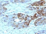 Blood Group H Antibody Colon Carcinoma IHC. Immunohistochemistry staining of FFPE human colon carcinoma tissue using Blood Group H Antibody demonstrates distinct membranous and apical HRP-DAB brown staining within gland-forming epithelial tumor cells. The staining pattern is consistent with expression of Blood Group H / H Type 2 antigen, a precursor carbohydrate epitope of the ABO blood group system expressed on cell surface glycoproteins and glycolipids. Clone 19-OLE highlights H antigen-positive epithelial tumor populations and supports the utility of this antibody for studies of blood group antigen biology, glycobiology, and tissue-specific glycosylation patterns. The observed staining is consistent with expression of H type 2 carbohydrate determinants in epithelial-derived neoplastic tissues.