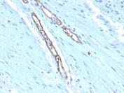 Blood Group Antigen A Antibody Colon Carcinoma IHC. Immunohistochemistry staining of FFPE human colon carcinoma tissue using Blood Group Antigen A Antibody demonstrates distinct membranous HRP-DAB brown staining within gland-forming epithelial tumor cells. The staining pattern is consistent with expression of Blood Group Antigen A / ABO Antigen A, a terminal carbohydrate epitope of the ABO blood group system expressed on cell surface glycoproteins and glycolipids. Clone HE-193 highlights ABO Antigen A-positive epithelial structures within the tumor, supporting the utility of this published antibody for studies of blood group antigen expression, glycobiology, and cell surface carbohydrate distribution in human tissues. Formalin-fixed, paraffin-embedded tissue stained with clone HE-193.