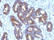 ABO Antibody Colorectal Carcinoma IHC. Immunohistochemistry staining of FFPE human colorectal carcinoma tissue using ABO Antibody demonstrates distinct membranous and apical HRP-DAB brown staining within gland-forming epithelial tumor cells. The staining pattern is consistent with expression of A and H chain carbohydrate antigens, cell surface glycan structures associated with the ABO blood group system. Clone HE-10 highlights carbohydrate epitope expression on neoplastic epithelial cells and supports the utility of this chain-selective antibody for studies of blood group antigen distribution, glycobiology, and tissue-specific glycosylation patterns. The observed staining is consistent with expression of ABO-associated carbohydrate determinants on epithelial-derived tumor tissues.