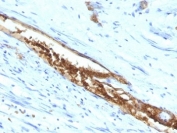 ABO Antibody Colon Carcinoma IHC. Immunohistochemistry staining of FFPE human colon carcinoma tissue using ABO Antibody demonstrates distinct membranous and apical HRP-DAB brown staining within gland-forming epithelial tumor cells. The staining pattern is consistent with expression of A and H type 3/4 chain carbohydrate antigens, specialized glycan structures associated with selected ABO blood group determinants. Clone 3-3A highlights epithelial cell populations expressing type 3 and type 4 chain-associated carbohydrate epitopes and supports the utility of this antibody for studies of blood group antigen distribution, glycobiology, and tissue-specific glycosylation patterns. The observed staining is consistent with expression of ABO-associated carbohydrate structures on epithelial-derived tumor tissues.