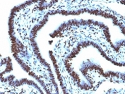 Histone H1 Antibody for IHC. Immunohistochemistry analysis of total histone H1 expression in FFPE human ovarian carcinoma tissue using Histone H1 Antibody. Nuclear HRP-DAB brown staining is observed in tumor epithelial cells, consistent with localization of linker histone H1 within chromatin and its role in higher-order chromatin organization. Clone AE-4 antibody demonstrates strong nuclear compartmentalization with minimal cytoplasmic staining, reflecting the chromatin-associated distribution of histone H1.