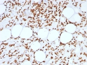 IHC: FFPE human angiosarcoma tested with Histone H1 antibody (clone AE-4).