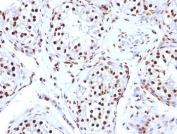 IHC: FFPE human testicular carcinoma tested with Histone H1 antibody (clone AE-4).