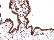 Histone H1 Antibody for IHC. Immunohistochemistry analysis of histone H1 variant family expression in FFPE human ovarian carcinoma tissue using Histone H1 Antibody. Nuclear HRP-DAB brown staining is observed in tumor epithelial cells, consistent with localization of linker histone H1 isoforms within chromatin and reflecting variant-associated chromatin organization. Clone HH1/957 antibody demonstrates strong nuclear compartmentalization with minimal cytoplasmic staining, highlighting broad detection of H1 family proteins across chromatin.
