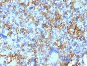 IHC staining of FFPE human histiocytoma tissue with HLA-DR antibody (clone LN3). HIER: boil tissue sections in pH 9 10mM Tris with 1mM EDTA for 20 min and allow to cool before testing.