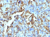 IHC: Formalin-fixed, paraffin-embedded human histiocytoma stained with HLA-DR antibody (LN3 + HLA-DRB/1067).
