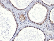 AR Antibody Clone AR441 immunohistochemistry of human prostate carcinoma. Formalin-fixed, paraffin-embedded human prostate carcinoma tissue stained with AR Antibody Clone AR441 shows strong nuclear HRP-DAB brown chromogenic staining in tumor epithelial cells, consistent with androgen receptor expression and the expected nuclear localization of this ligand-activated transcription factor. Surrounding stromal elements display minimal staining, highlighting the epithelial predominance of AR-positive cells in prostate carcinoma.