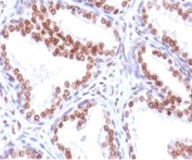 Androgen Receptor Antibody Clone SPM335 immunohistochemistry of human prostate carcinoma. Formalin-fixed, paraffin-embedded human prostate carcinoma tissue stained with Androgen Receptor Antibody Clone SPM335 shows strong nuclear HRP-DAB brown chromogenic staining in tumor epithelial cells, consistent with androgen receptor expression and the expected nuclear localization of this ligand-activated steroid hormone receptor. Surrounding stromal cells demonstrate minimal staining, highlighting the epithelial predominance of AR-positive tumor cells within the carcinoma tissue.