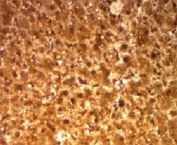 Arginase Antibody Microarray Specificity Validated (clone ARG1/1126) immunohistochemistry of human hepatocellular carcinoma. Formalin-fixed, paraffin-embedded human hepatocellular carcinoma tissue stained with the mouse monoclonal Arginase Antibody Microarray Specificity Validated (clone ARG1/1126) shows strong cytoplasmic HRP-DAB brown chromogenic staining in malignant hepatocyte-derived tumor cells, consistent with the known hepatic expression of Arginase-1 (ARG1). The staining pattern highlights the cytoplasmic localization of this urea cycle enzyme within tumor cells. Heat-induced epitope retrieval was performed by boiling tissue sections in pH 9 10mM Tris with 1mM EDTA for 10-20 min followed by cooling at room temperature prior to antibody incubation.