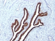 IHC: Formalin-fixed, paraffin-embedded human ovarian carcinoma stained with Keratin 7 antibody (KRT7/760 + KRT7/903)
