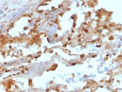 Keratin 8 Antibody Lung Carcinoma IHC. Immunohistochemical staining of FFPE human lung carcinoma tissue using Keratin 8 Antibody (clone KRT8/803) demonstrates strong cytoplasmic HRP-DAB brown staining within malignant epithelial cells. The staining pattern is consistent with expression of Cytokeratin 8 (KRT8), a type II intermediate filament protein widely expressed in simple epithelial tissues and epithelial-derived malignancies. Cytokeratin 8 immunoreactivity highlights neoplastic epithelial cell populations and supports evaluation of epithelial differentiation in lung carcinoma specimens.