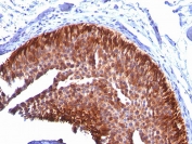 IHC: Formalin-fixed, paraffin-embedded human bladder carcinoma stained with Cytokeratin 17 antibody (KRT17/778).