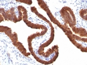 IHC: Formalin-fixed, paraffin-embedded human ovarian carcinoma stained with Cytokeratin 19 antibody (KRT19/799).