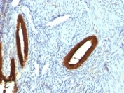 IHC: Formalin-fixed, paraffin-embedded human endometrial carcinoma stained with CK19 antibody (KRT19/800)