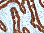 IHC: Formalin-fixed, paraffin-embedded human ovarian carcinoma stained with CK19 antibody (clone KRT19/800).