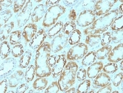 Immunohistochemistry analysis of Laminin gamma 1 / LAMC1 antibody (clone A5) in human renal cell carcinoma tissue. Formalin-fixed, paraffin-embedded human renal cell carcinoma tissue was stained using Laminin gamma 1 antibody (clone A5). Brown chromogenic signal is observed outlining basement membrane structures surrounding tumor nests and vascular profiles, producing a delicate linear and reticular staining pattern consistent with extracellular matrix localization. Tumor cell cytoplasm shows minimal staining, while stromal regions demonstrate variable basement membrane-associated signal. This staining pattern reflects basement membrane-associated expression of Laminin gamma 1 in renal cell carcinoma.