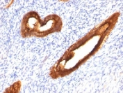 Formalin-fixed, paraffin-embedded human endometrial carcinoma stained with MUC1 antibody (MUC1/520).