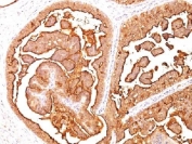 Formalin-fixed, paraffin-embedded human breast carcinoma stained with MUC1 antibody (MUC1/520).