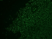 Nucleolin Antibody CF488 Conjugate for IF immunofluorescence analysis of human colon carcinoma tissue. Immunofluorescent staining of human colon carcinoma with Nucleolin Antibody CF488 Conjugate (clone NCL/902). Direct CF488 labeling produces bright green fluorescence highlighting nuclei and nucleolar compartments consistent with the expected nuclear localization of Nucleolin / NCL in tumor cells.