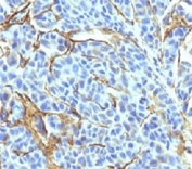IHC: Formalin-fixed, paraffin-embedded human melanoma stained with NGFR antibody (NTR/912).