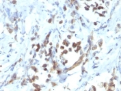 PAX6 Antibody Gastric Carcinoma IHC. Immunohistochemical staining of formalin fixed, paraffin embedded human gastric carcinoma demonstrates PAX6 expression using PAX6 antibody clone PAX6/1166. PAX6 is a highly conserved transcription factor that regulates cellular differentiation and developmental programs and is essential for eye and nervous system development. Predominantly nuclear staining is observed in malignant epithelial cells, consistent with the role of PAX6 as a DNA binding protein involved in transcriptional regulation. These findings support the utility of PAX6 Antibody for studies of developmental signaling, stem cell biology, and cancer progression.