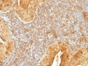 IHC analysis of formalin-fixed, paraffin-embedded human salivary tumor stained with Cytochrome C antibody (clone 7H8.2C12).