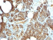 PTH Antibody C Terminus immunohistochemistry of human parathyroid gland. FFPE human parathyroid tissue stained with PTH Antibody C Terminus / Parathyroid Hormone Antibody clone PTH/1173, a mouse monoclonal antibody recognizing the C-terminal region of Parathyroid hormone (PTH). Strong cytoplasmic brown chromogenic staining is observed in parathyroid endocrine chief cells, consistent with the expected intracellular localization of Parathyroid hormone within hormone-producing cells of the parathyroid gland.