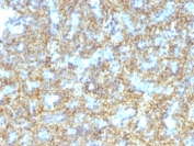 PTH Antibody Immunohistochemistry analysis of Parathyroid hormone in human parathyroid tissue. FFPE human parathyroid tissue was stained using PTH antibody clone PTH/1174 following heat induced epitope retrieval prior to staining. HRP-DAB brown chromogenic signal highlights strong cytoplasmic staining in parathyroid endocrine chief cells arranged in nests and cords, consistent with the known expression of Parathyroid hormone (PTH), a key regulator of calcium homeostasis produced by parathyroid gland cells. The staining pattern demonstrates robust detection of hormone-producing endocrine tissue and supports the use of PTH Antibody Immunohistochemistry / Parathyroid Hormone (clone PTH/1174) for immunohistochemistry analysis of PTH expression in FFPE tissue sections.