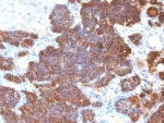 PTH Antibody Immunohistochemistry analysis of Parathyroid hormone in human parathyroid tissue. FFPE human parathyroid tissue was stained using PTH antibody clone PTH/1174 following heat induced epitope retrieval prior to staining. HRP-DAB brown chromogenic signal highlights strong cytoplasmic staining in parathyroid endocrine chief cells arranged in dense nests, consistent with the known expression of Parathyroid hormone (PTH), a peptide hormone produced by parathyroid gland cells that regulates systemic calcium homeostasis. This staining pattern demonstrates robust detection of hormone-producing endocrine tissue and supports the use of PTH Antibody Immunohistochemistry / Parathyroid Hormone (clone PTH/1174) for immunohistochemistry analysis of PTH expression in FFPE tissue sections.