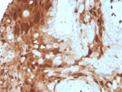 IHC staining of FFPE human breast cancer tissue with S100A9 antibody (clone S100A9/1075). HIER: boil tissue sections in pH 9 10mM Tris with 1mM EDTA for 20 min and allow to cool before testing.