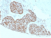 IHC staining of FFPE human breast cancer tissue with S100A9 antibody (clone S100A9/1075). HIER: boil tissue sections in pH 9 10mM Tris with 1mM EDTA for 20 min and allow to cool before testing.