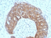 Estrogen Inducible Protein pS2 Antibody Clone SPM313. Immunohistochemistry analysis of Trefoil factor 1 (TFF1) in formalin-fixed, paraffin-embedded human ovarian carcinoma tissue using Estrogen Inducible Protein pS2 Antibody Clone SPM313. Tumor epithelial cells show HRP-DAB brown cytoplasmic staining, consistent with expression of the estrogen regulated secretory protein TFF1 (pS2). Hematoxylin counterstain highlights nuclei (blue) while surrounding stromal elements remain largely negative.