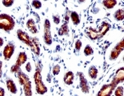 TFF1 Antibody Mouse Monoclonal Clone TFF1/1091. Immunohistochemistry analysis of Trefoil factor 1 (TFF1) in formalin-fixed, paraffin-embedded human breast carcinoma tissue using TFF1 Antibody Mouse Monoclonal Clone TFF1/1091. Tumor epithelial cells show HRP-DAB brown cytoplasmic staining consistent with expression of the estrogen regulated secretory peptide TFF1 (pS2). Hematoxylin counterstain highlights nuclei (blue).